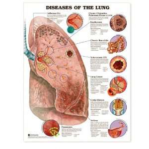 Diseases of the Lung Anatomical Chart Paper Unmounted  